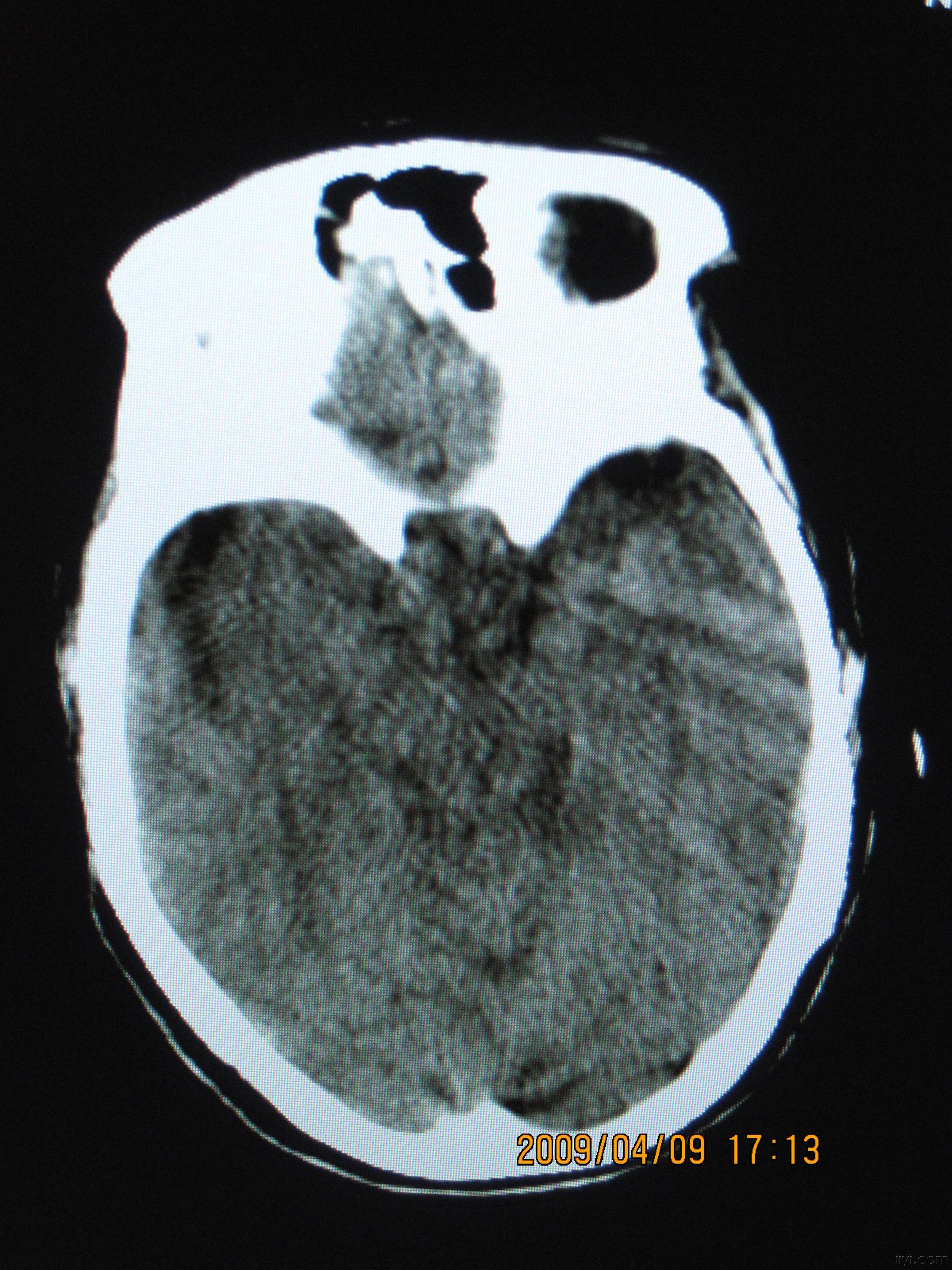 头颅ct平扫图象