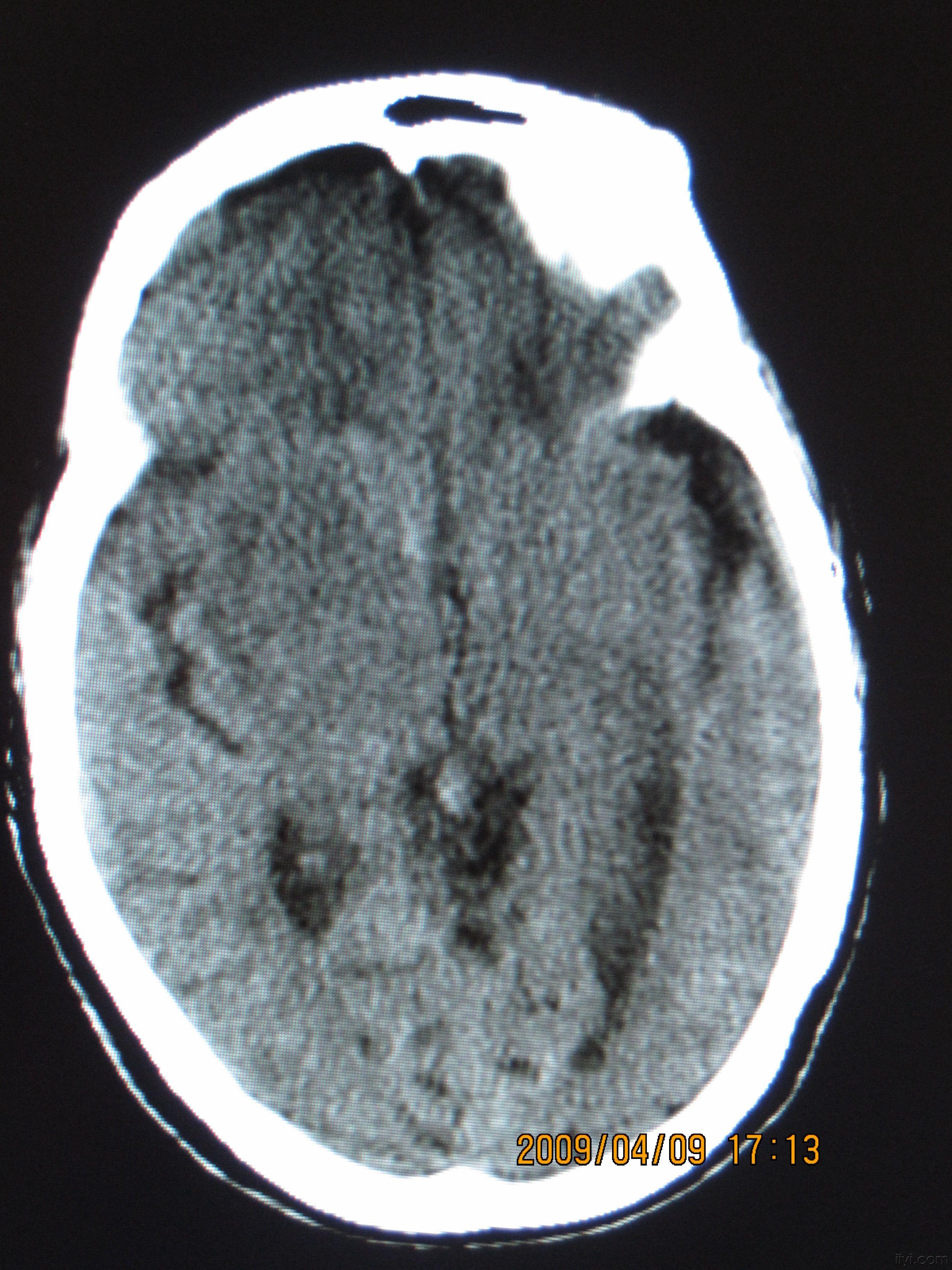 头颅ct平扫图象