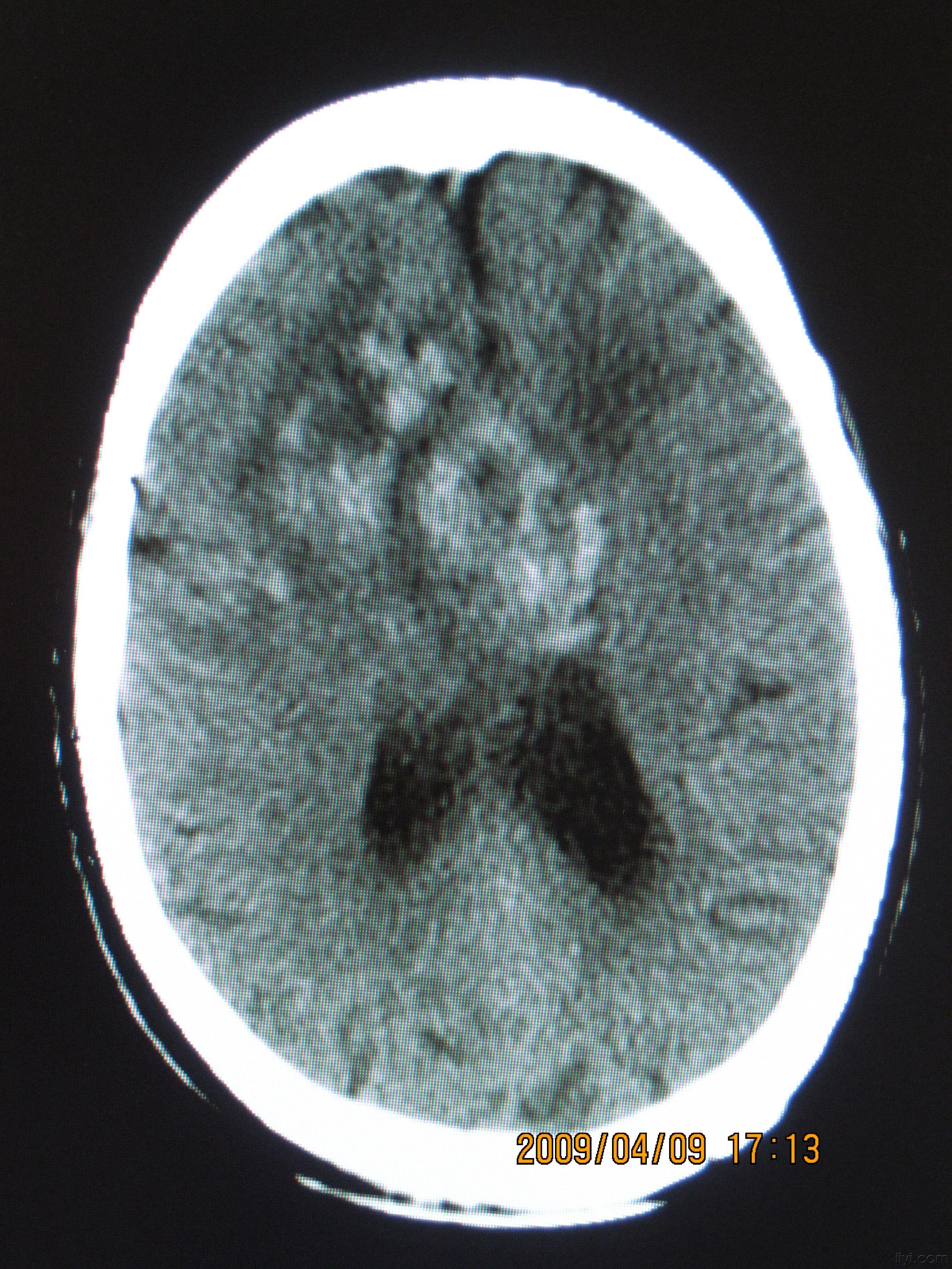 头部ct照片图片