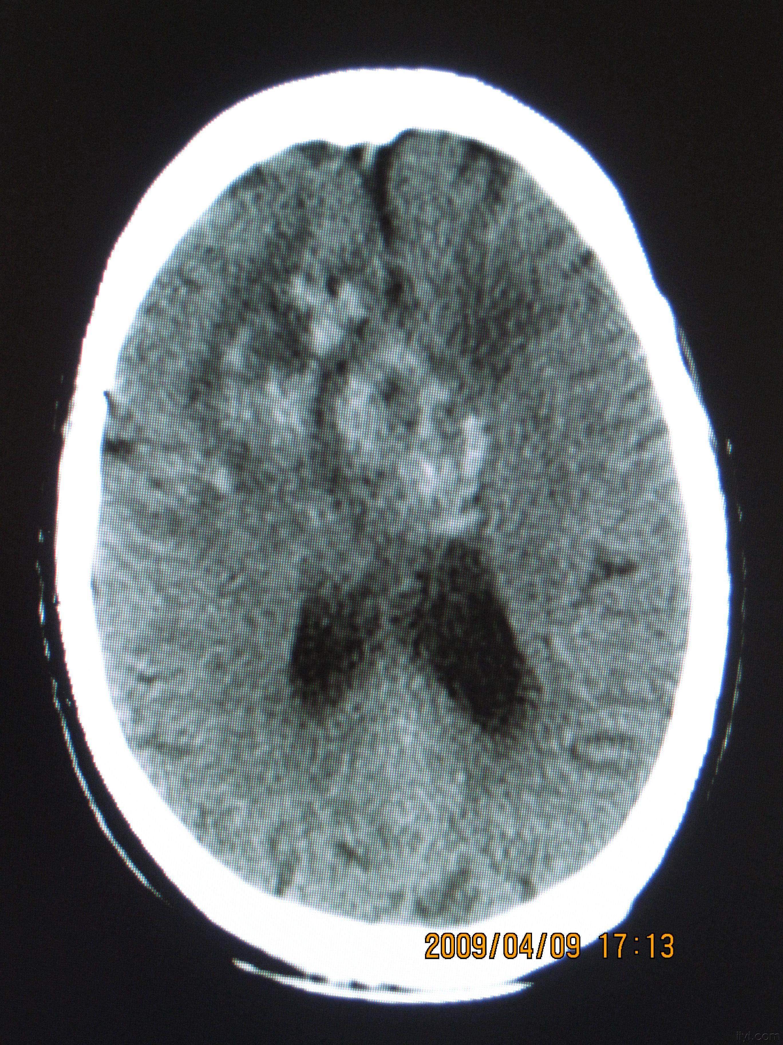 头颅ct平扫图象