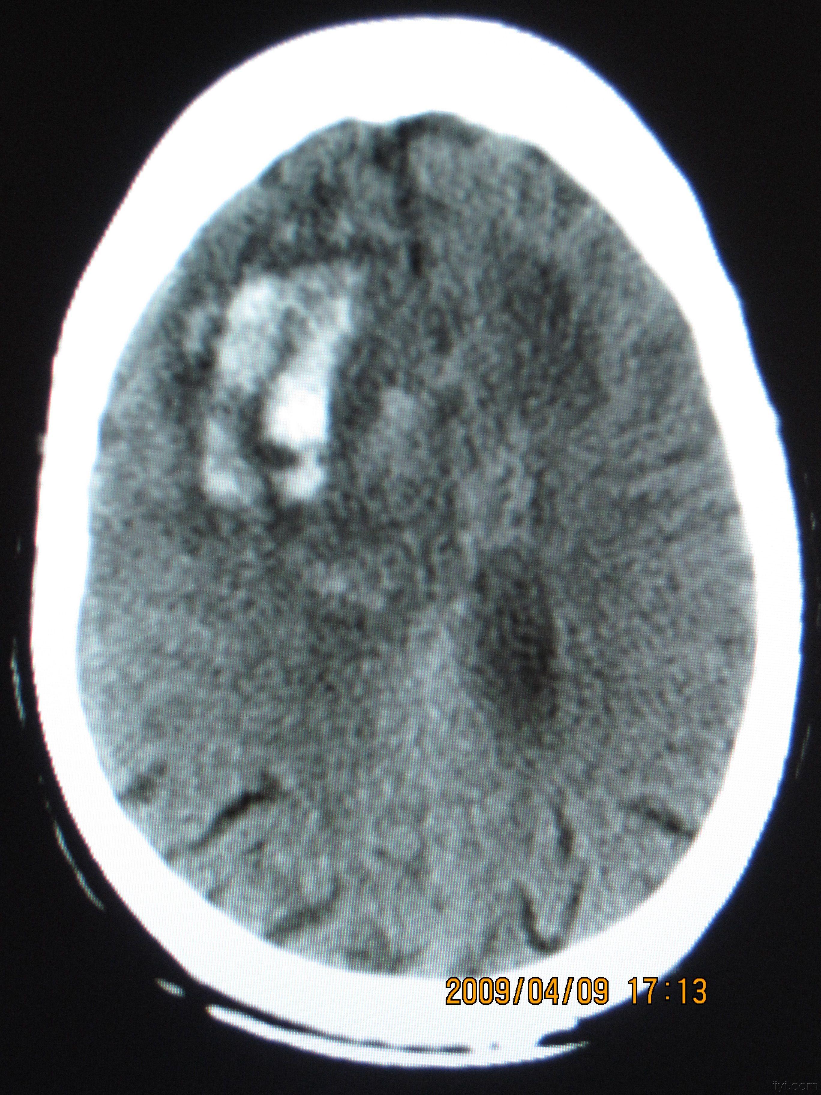 头颅ct平扫图象