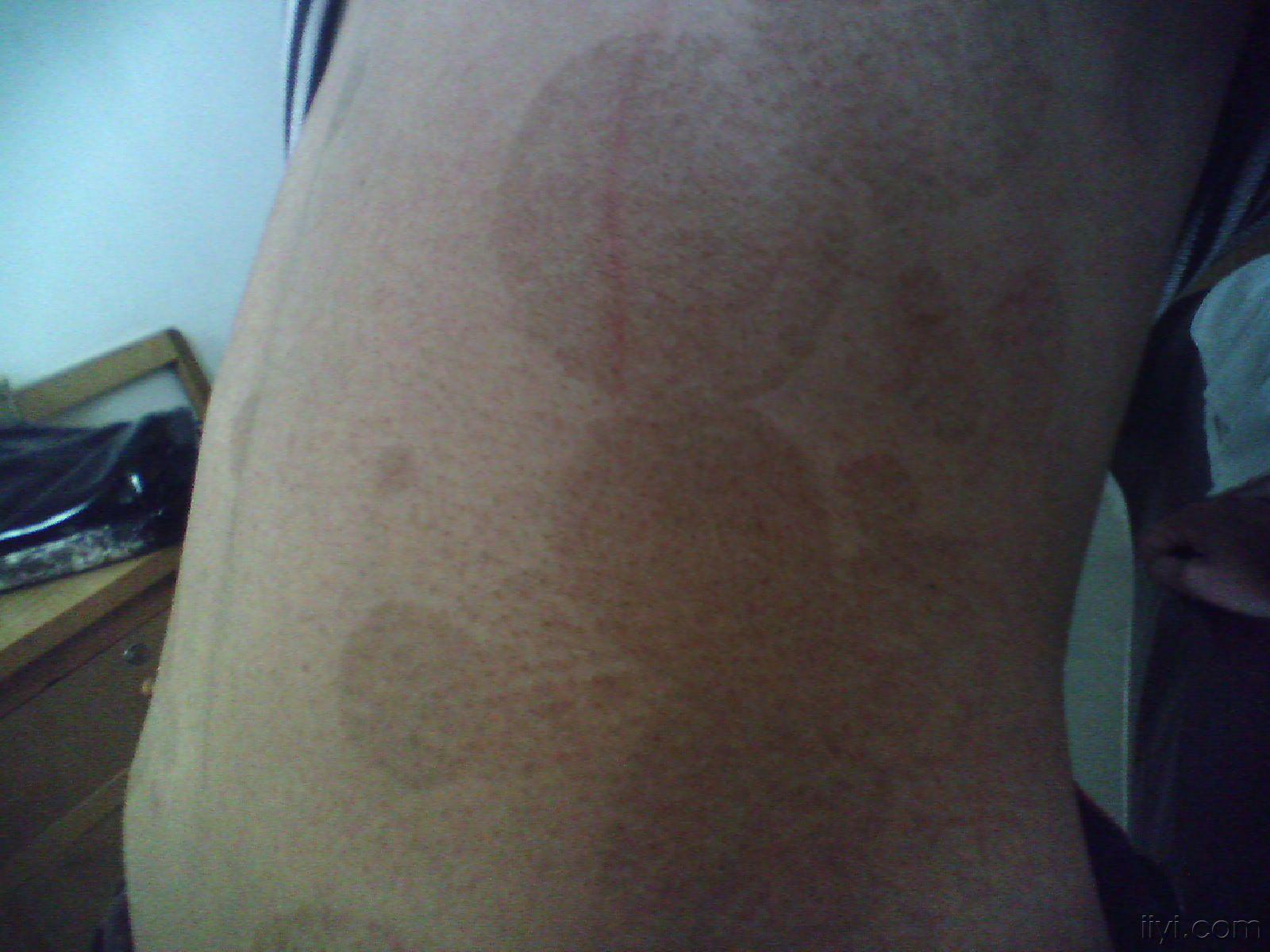 连圈状秕糠疹(远山)