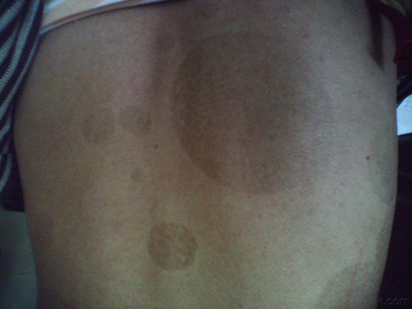 连圈状秕糠疹(远山)