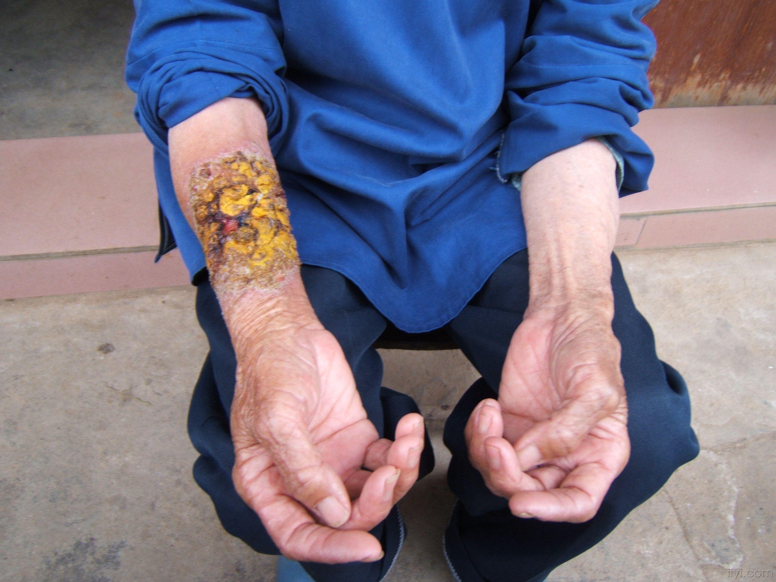 大家看这个是什么病?