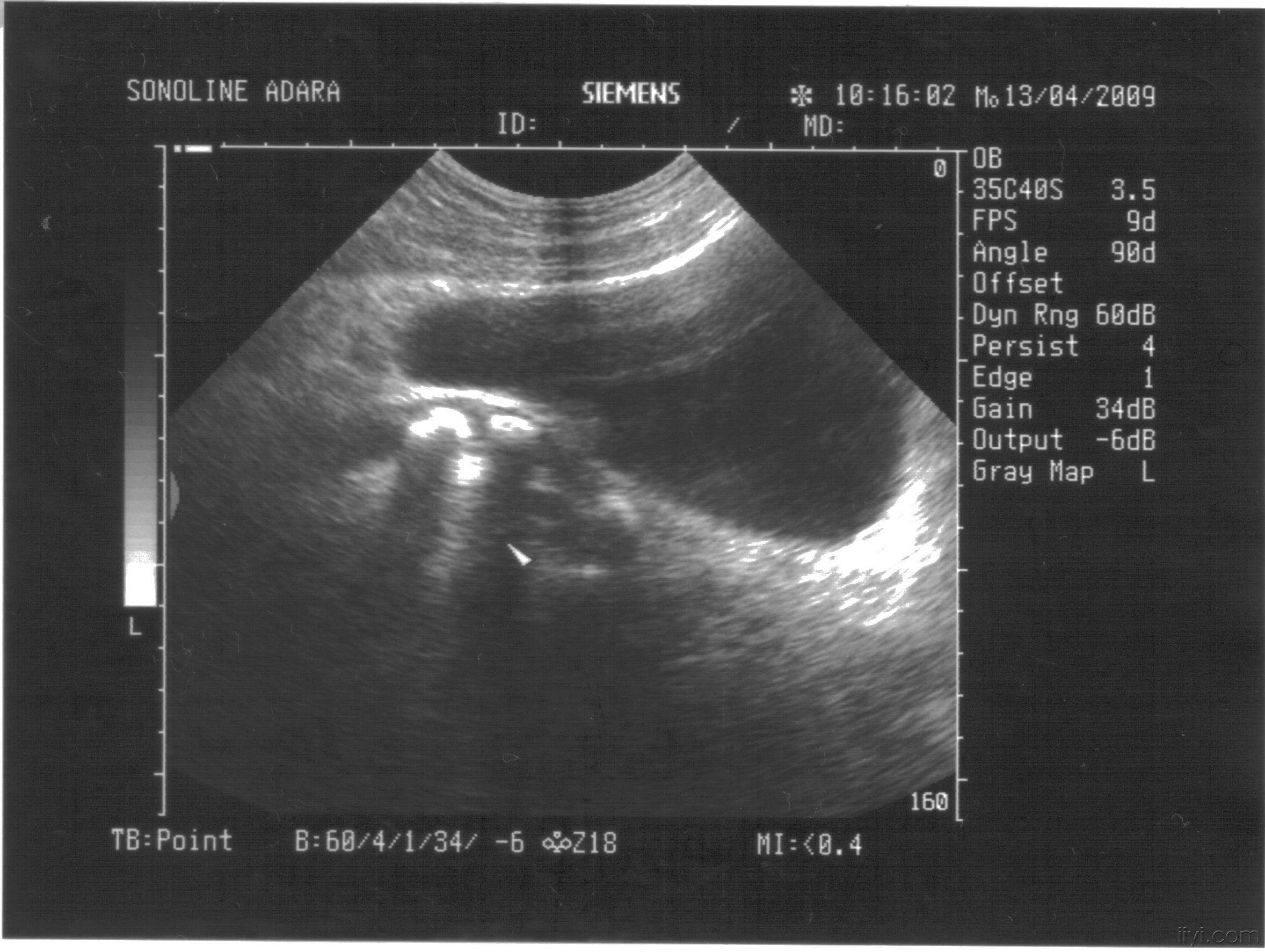 罕见的输尿管三结石