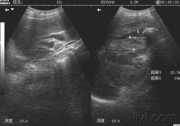 厚壁型膽囊癌一例 - 超聲醫學討論版 - 愛愛醫醫學論壇