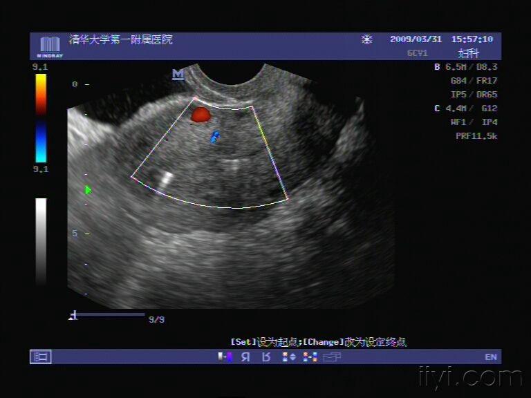 阴超发现就是一个子宫