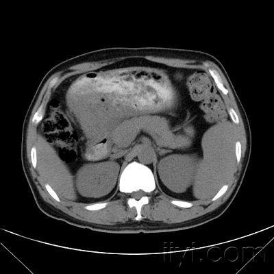 胃ca病例图像