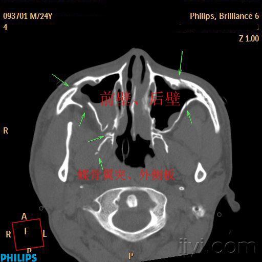093701-上颌窦前后壁,翼突.jpg
