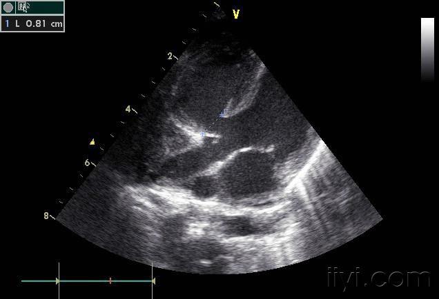 原创主动脉弓缩窄的超声表现