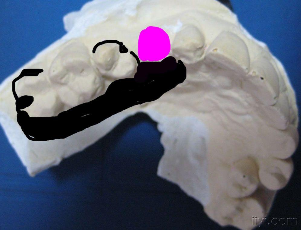 如何用可摘修复有楔状缺损病例 - 口腔医学专业讨论版 - 爱爱医医学