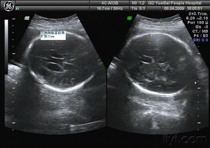 侧脑室超声图像图片