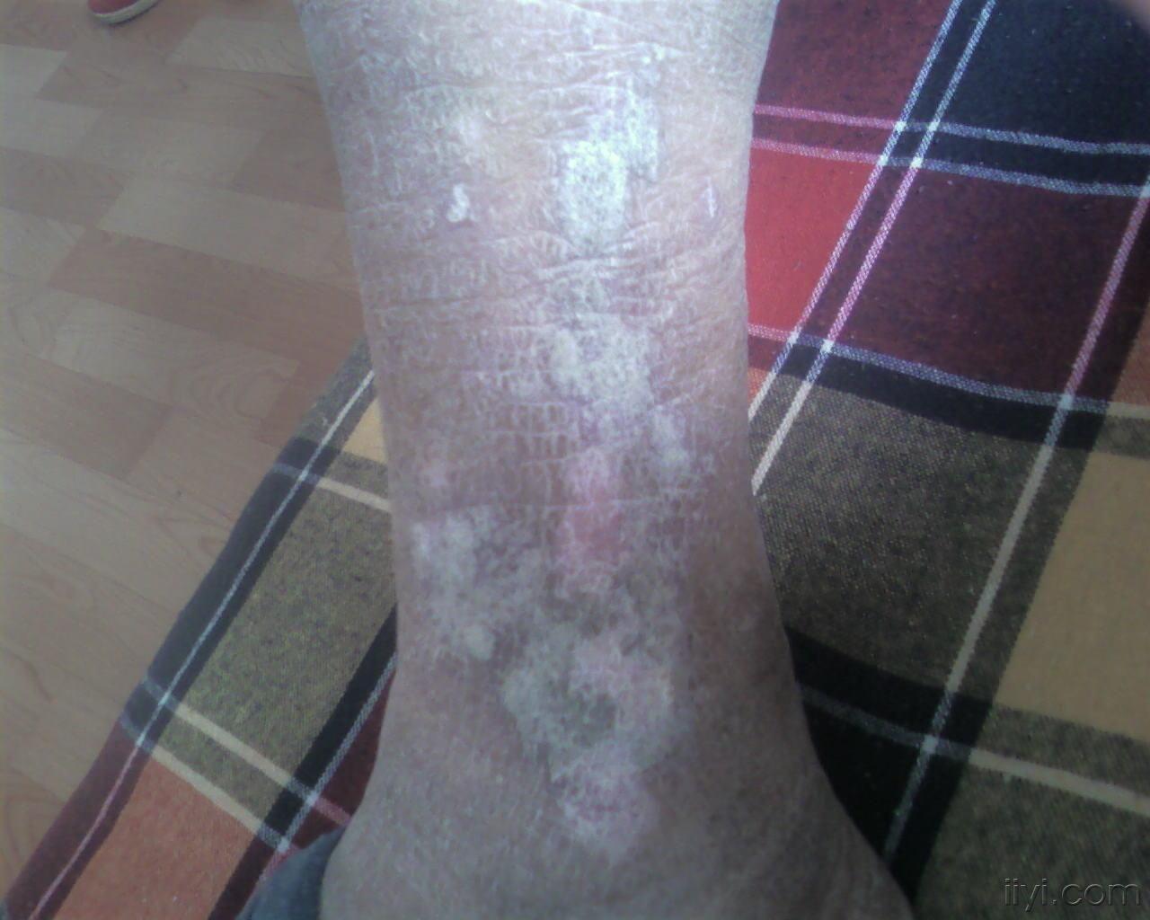 湿疹,神经性皮炎,过敏性皮炎,老年瘙痒症的 诊断和治疗 - 皮肤及性