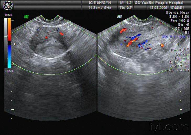 粘膜下肌瘤超声图片图片