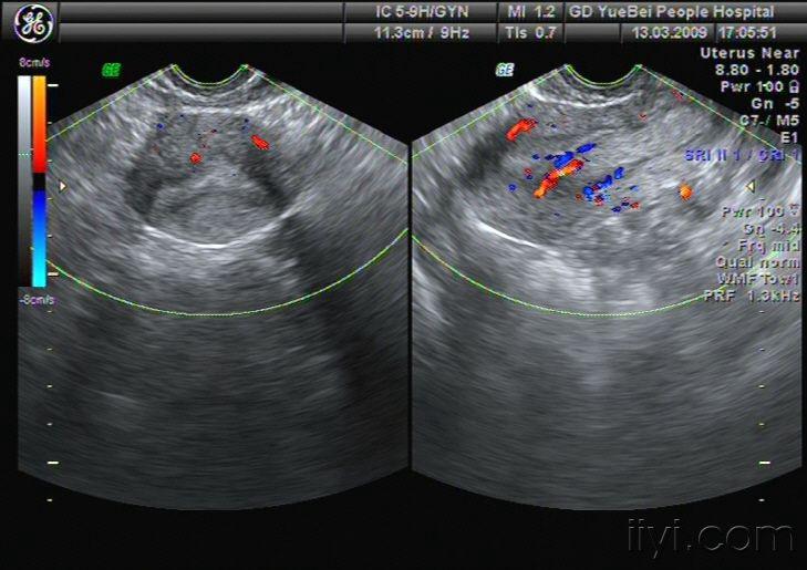 子宫肌瘤超声图像图片