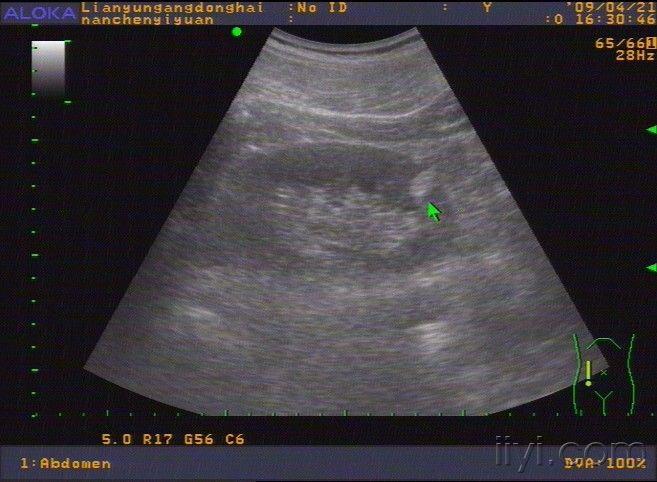 肾脏错构瘤? - 超声医学讨论版 - 爱爱医医学论坛