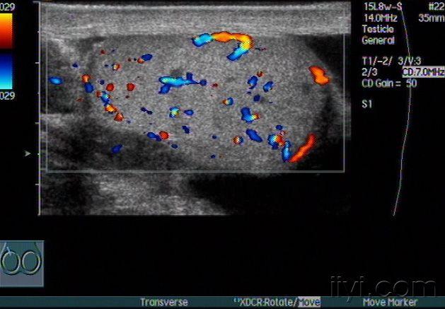 睾丸炎性结节图片