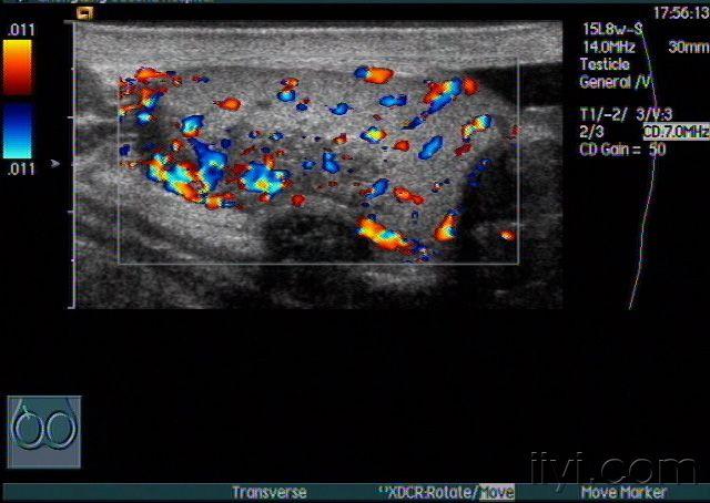 睾丸炎性结节图片