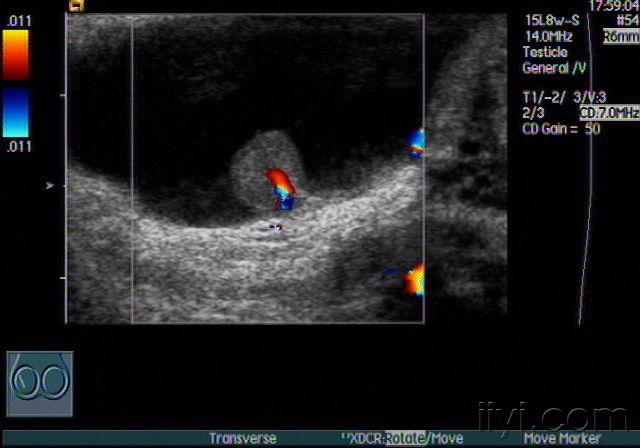 睾丸结节图片库图片