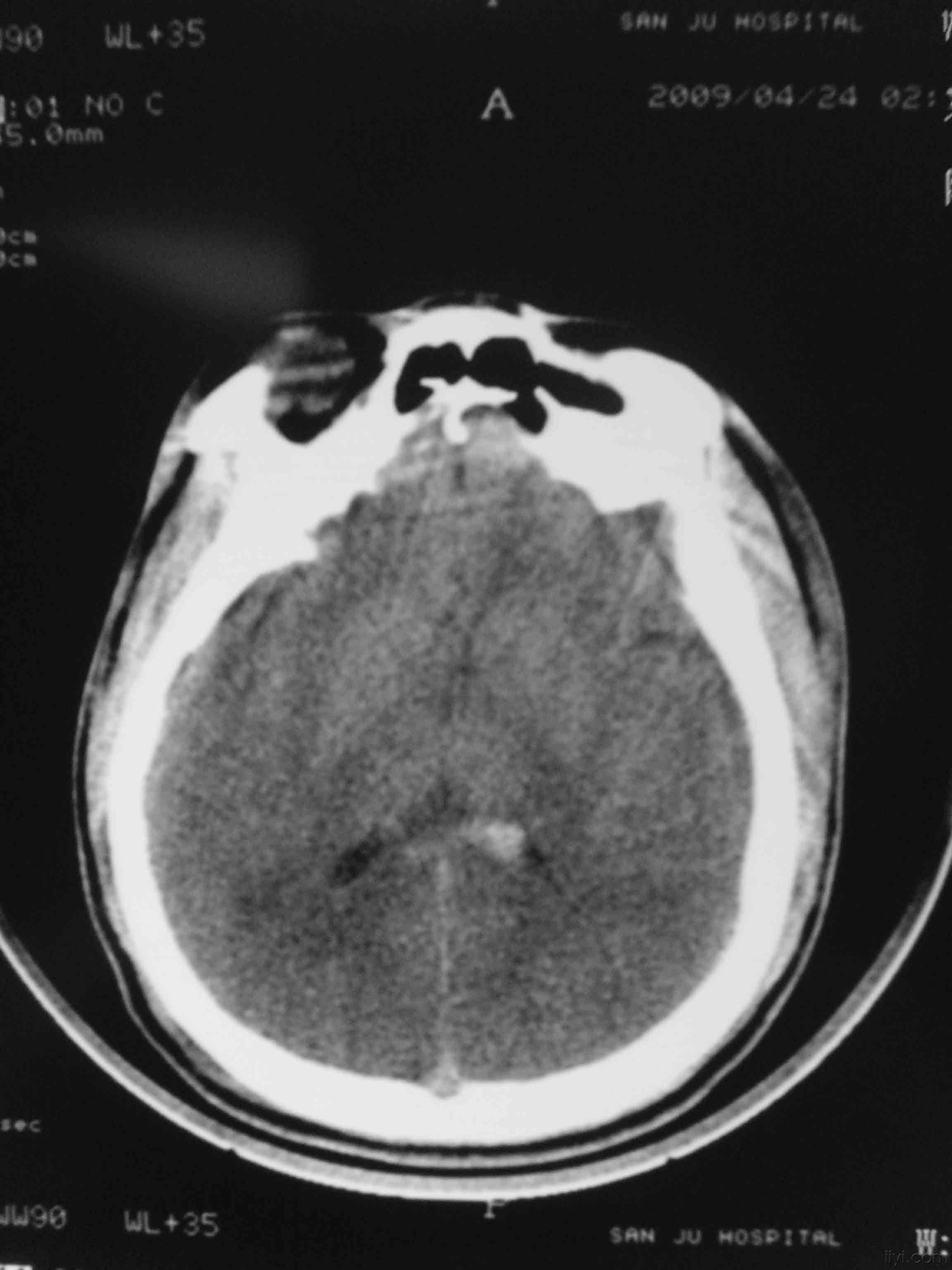 脑外伤一例求解