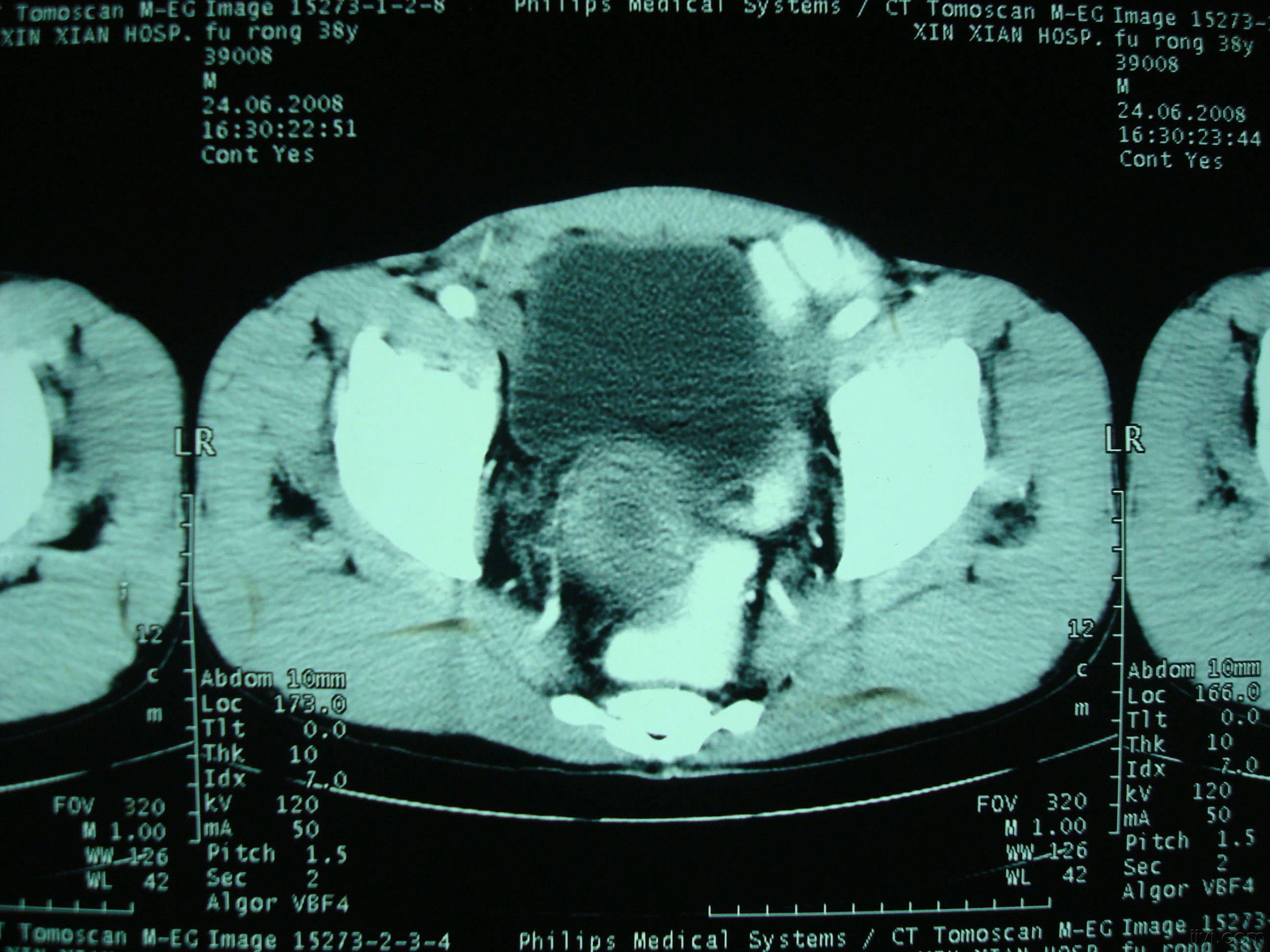 前列腺增生CT图片