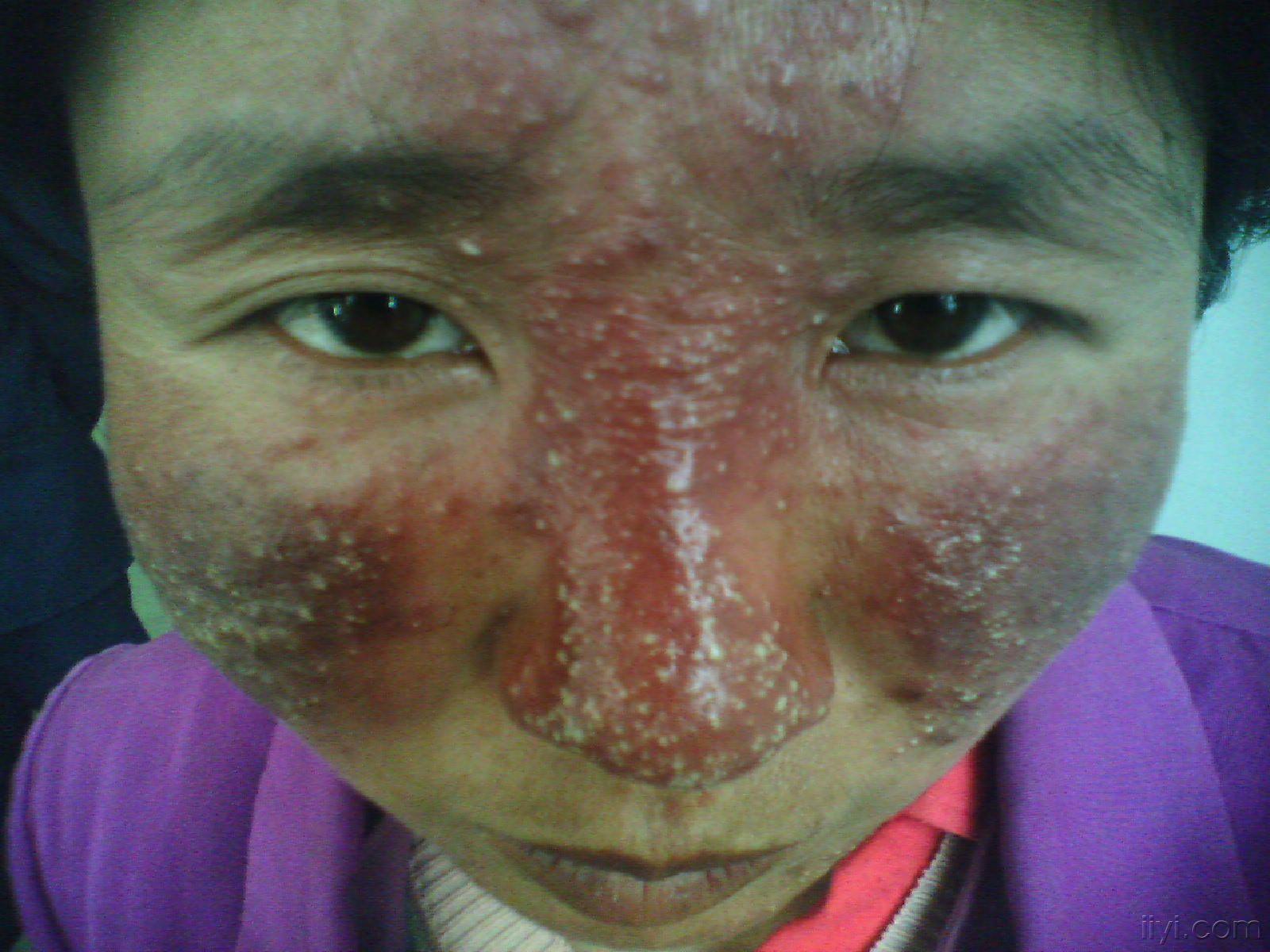 治疗前后的颜面部皮肤病附图