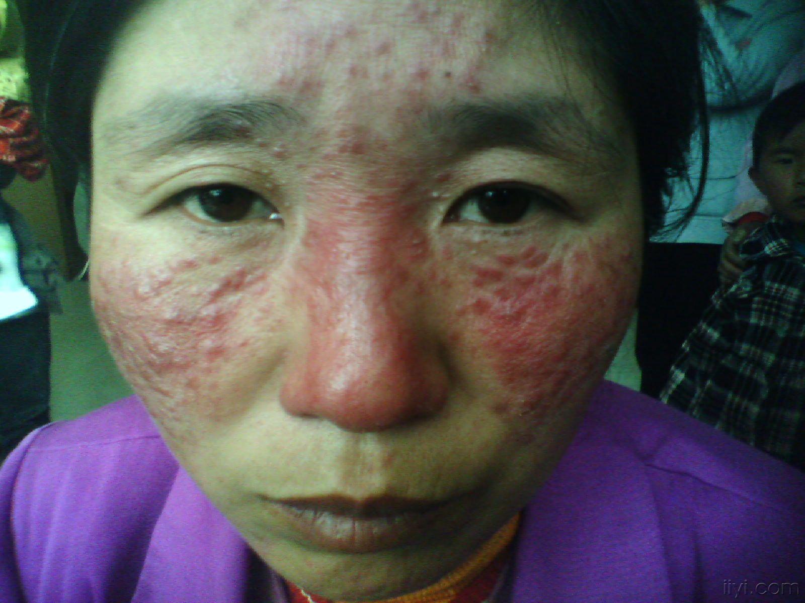 治疗前后的颜面部皮肤病附图