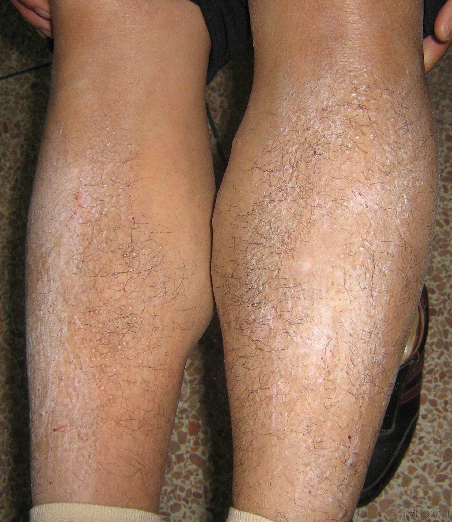 双胫前皮疹,剧痒10余年. - 皮肤及性传播疾病讨论版 - 爱爱医医学论坛