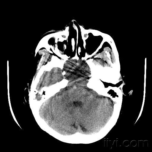 蝶窦病变我的诊断可脑外科主任不同请各位高手指点一下