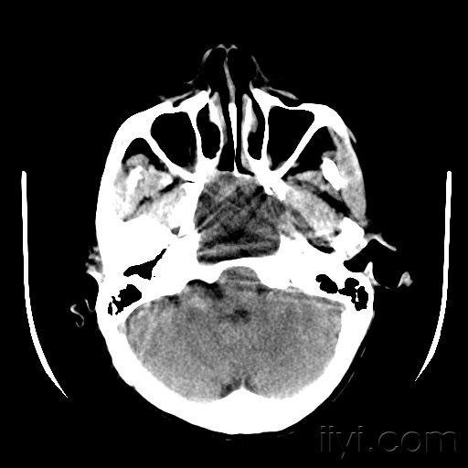 蝶窦病变我的诊断可脑外科主任不同请各位高手指点一下