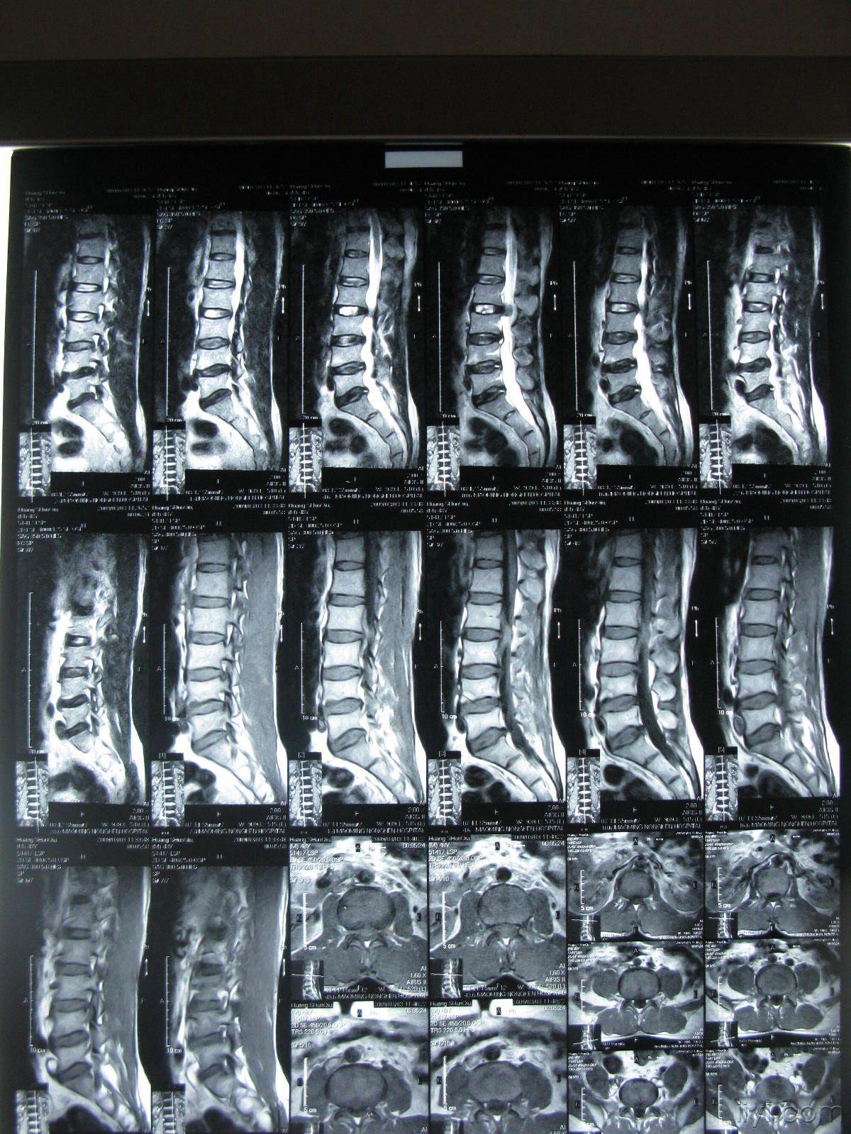 椎管内骨性占位图片图片
