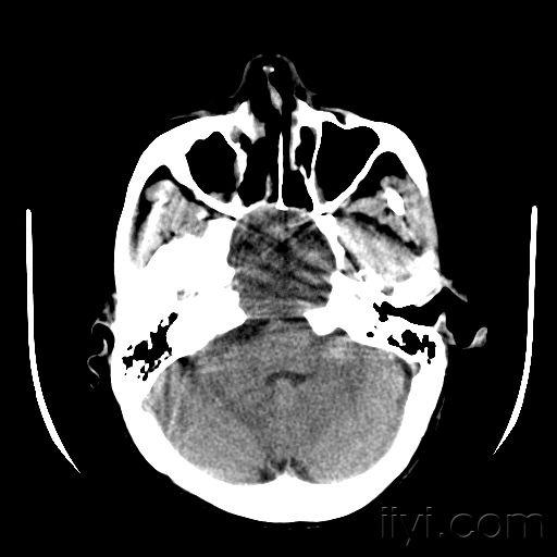 蝶窦病变我的诊断可脑外科主任不同请各位高手指点一下