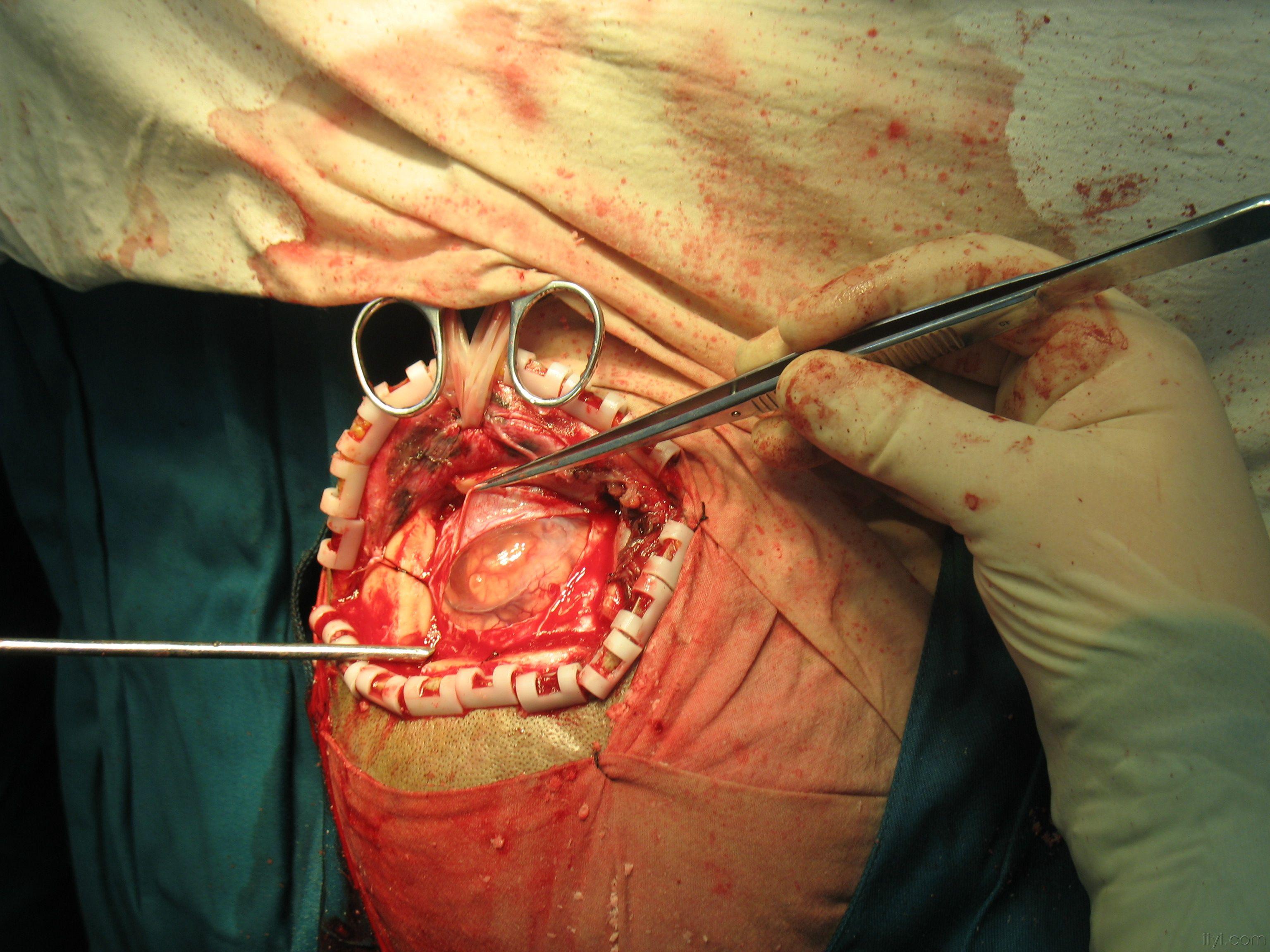 蛛网膜囊肿手术图片