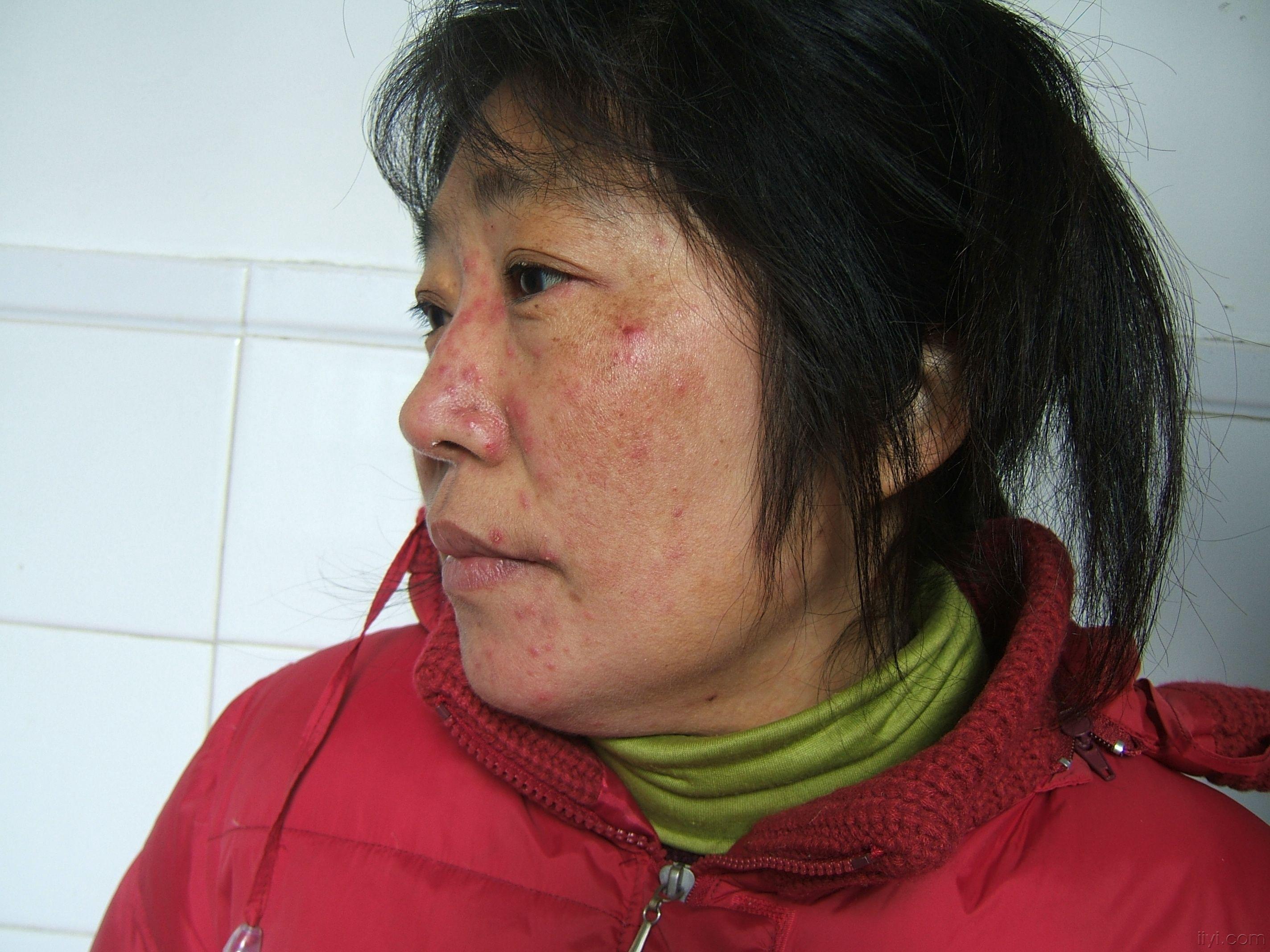面部红丘疹15年长期使用各种激素药膏