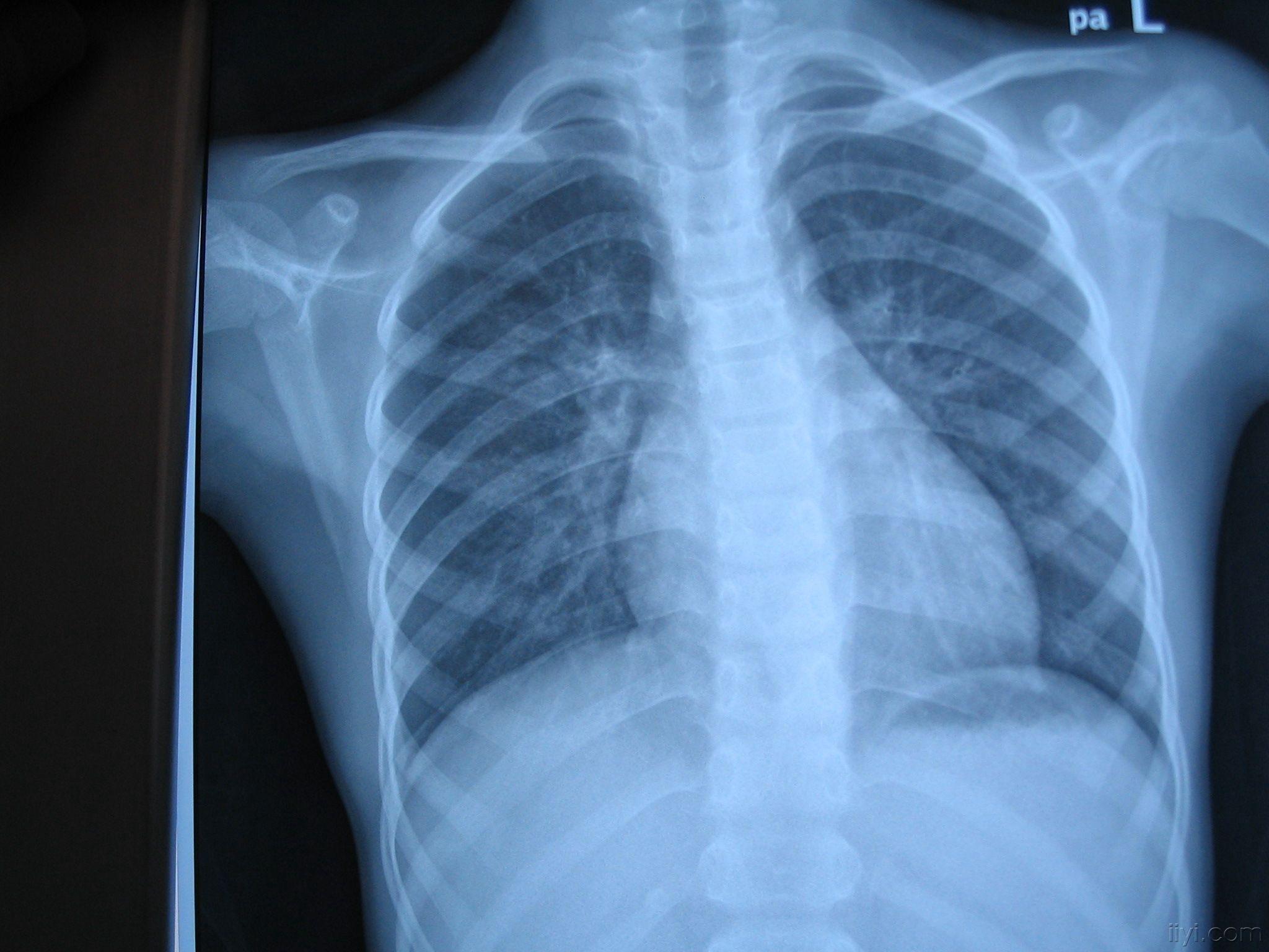 气管炎胸片图片