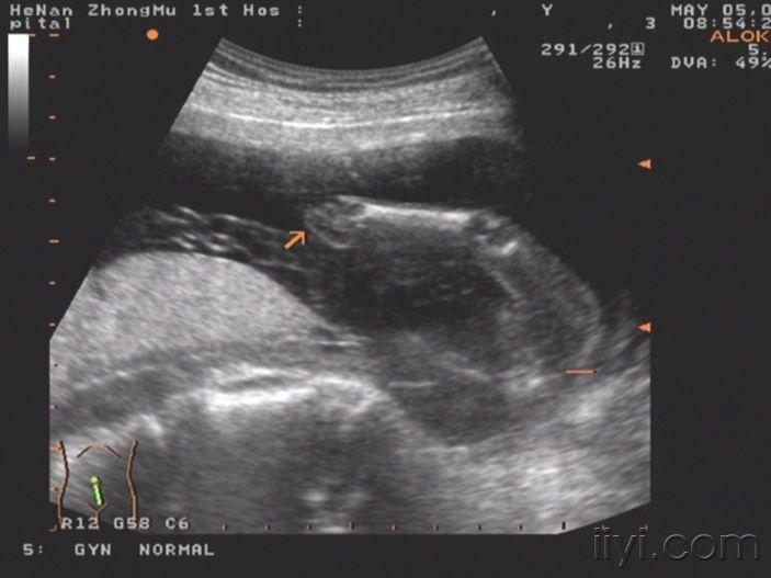 【讨论】双胎之一无头无心畸形合并另一胎儿复杂畸形!