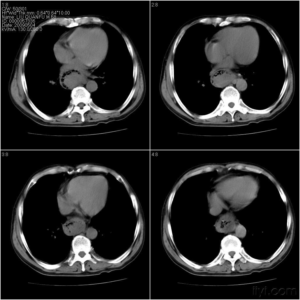 进行性吞咽困难什么意思 20090505_faf07917479aebd152e20I01xc8wX5I1.jpg