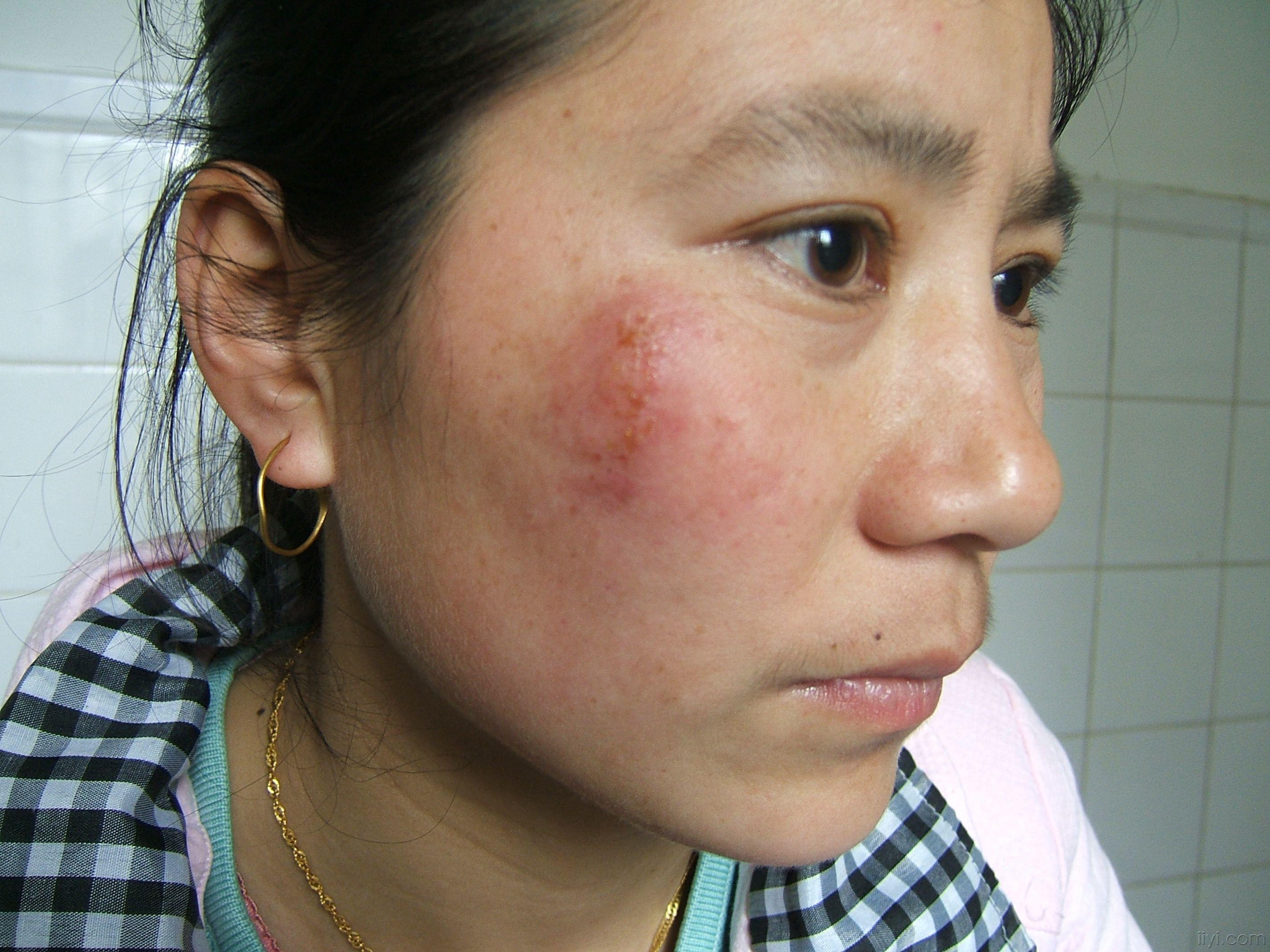 面部单纯疱疹15年每年要发好几次有什么可以根治的方法呀?