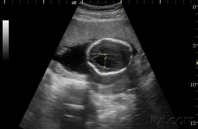 谁发一张4或5或6个月的胎儿脑积水的b超图片