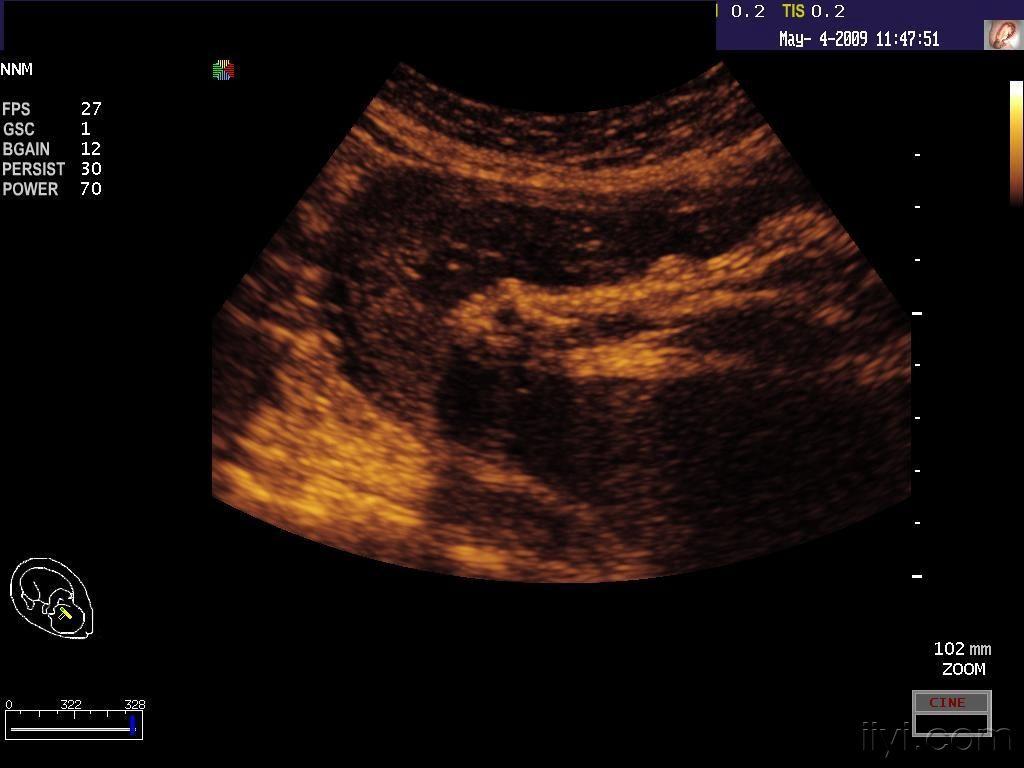 [产科] 两例胎儿发育异常