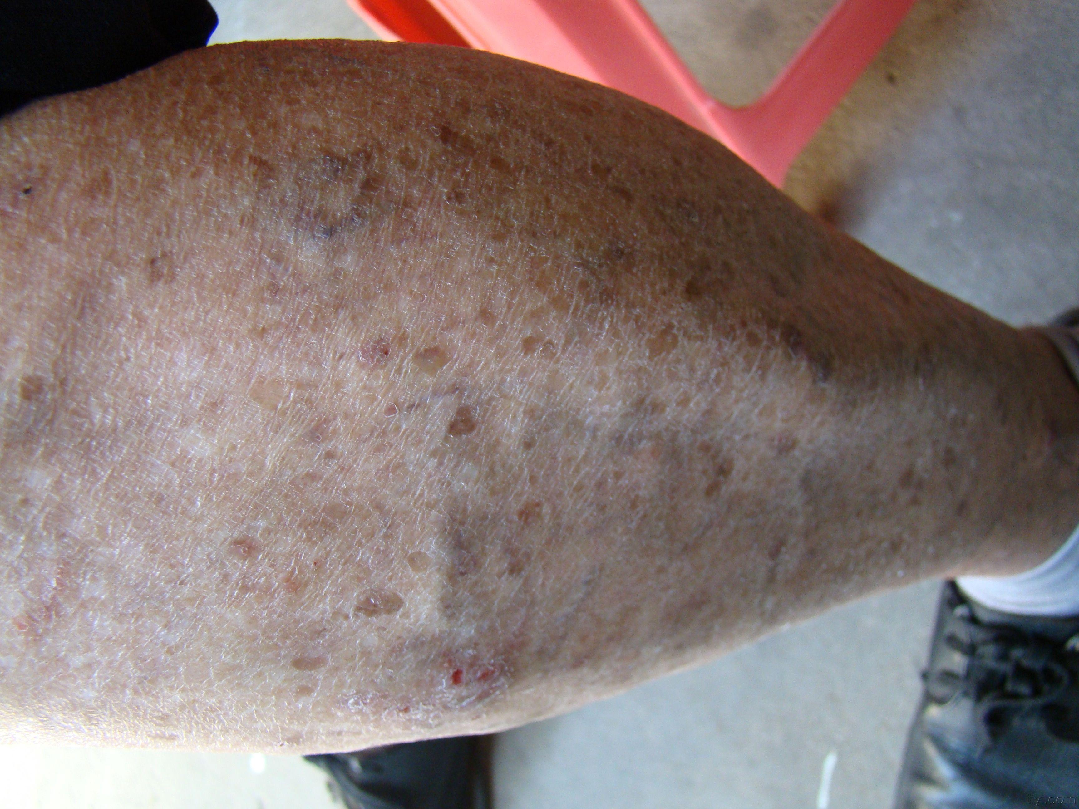 有意思我今天也收了个图片差不多的患者  不过我是拟诊为淤积性皮炎