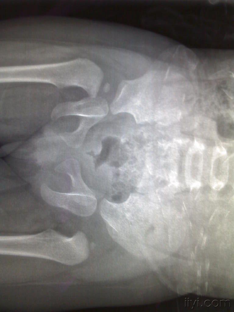 请教小孩股骨头髋臼病变