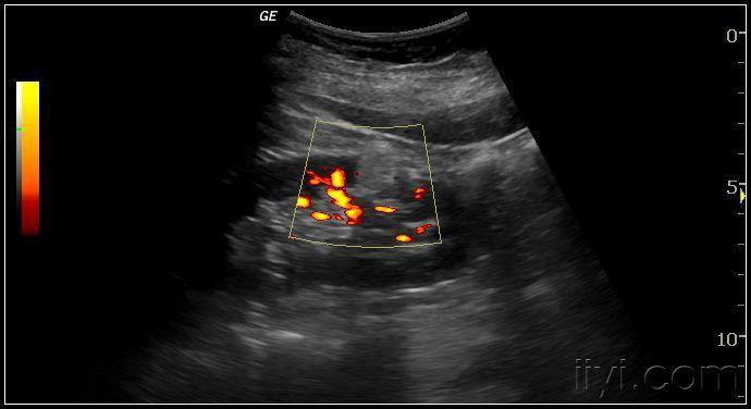 肾脏错构瘤 超声医学讨论版 爱爱医医学论坛