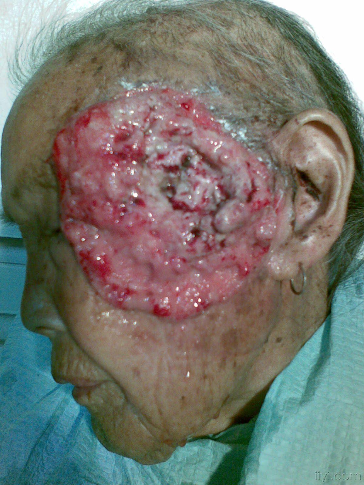 皮肤癌 初期图片