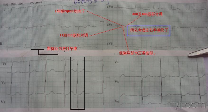 請幫忙分析 - 心電圖腦電圖專業討論版 - 愛愛醫醫學論壇