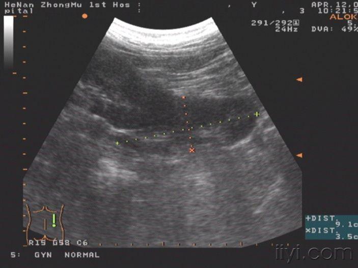【读片】横过型融合肾一例! - 超声医学讨论版 - 爱爱医医学论坛