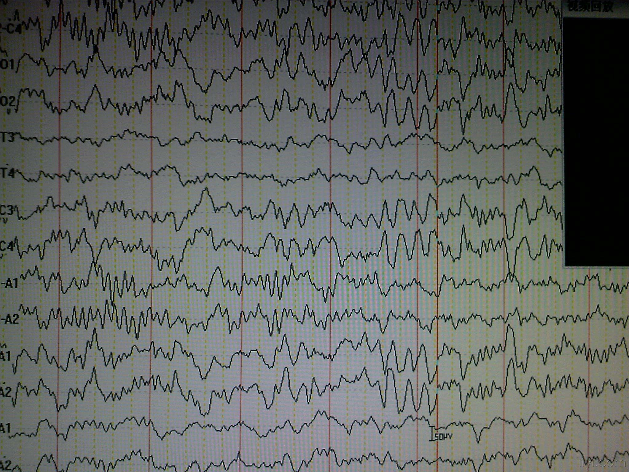 脑电图求助看图