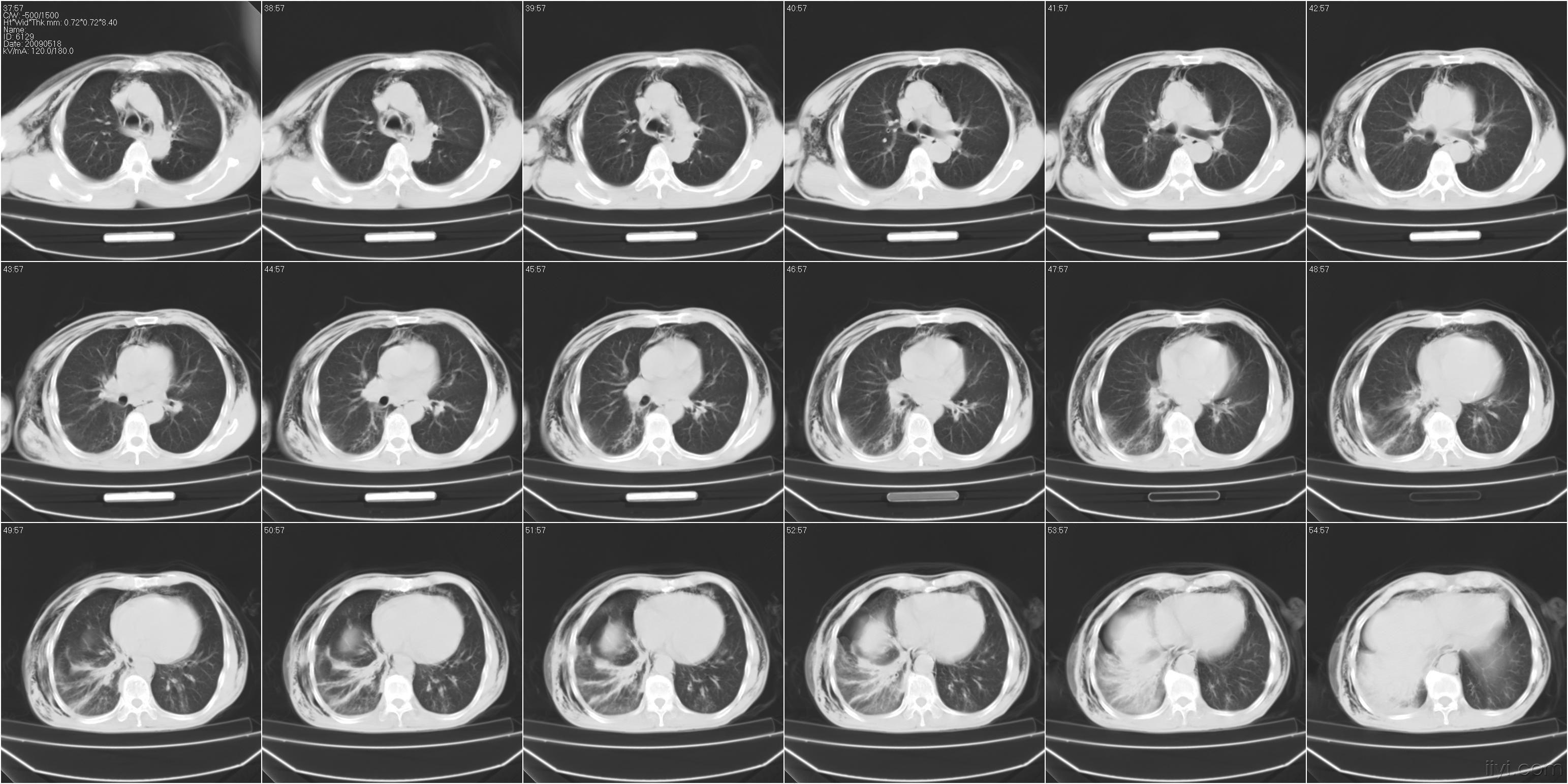 胸部外伤ct请教右下肺改变