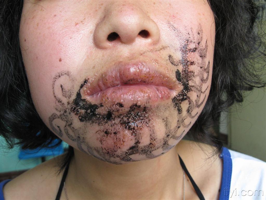 飘亮美图(隐翅虫皮炎)