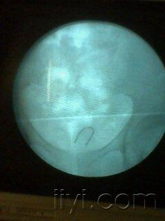 避孕环断裂一例